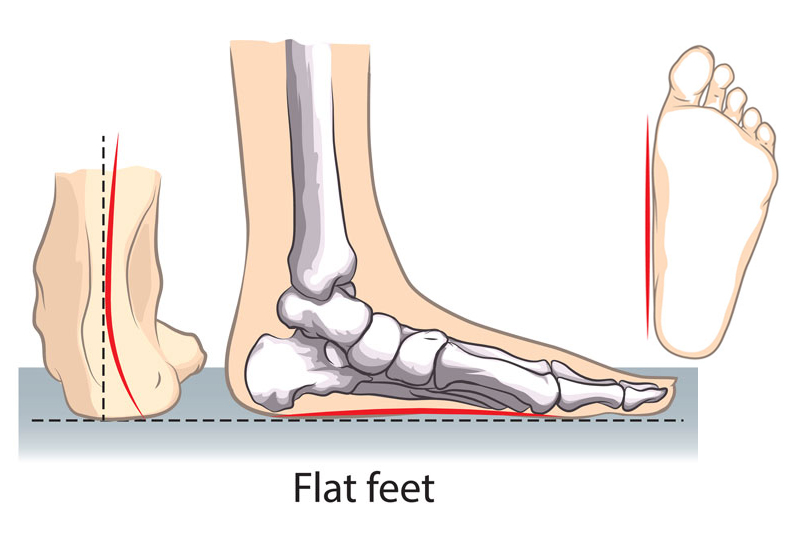 Flat Foot and Posterior Tibial Tendon Tears
