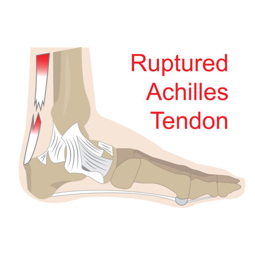 Achilles Tendonitis, Tendinosis and Rupture - Eastside Orthopedics ...